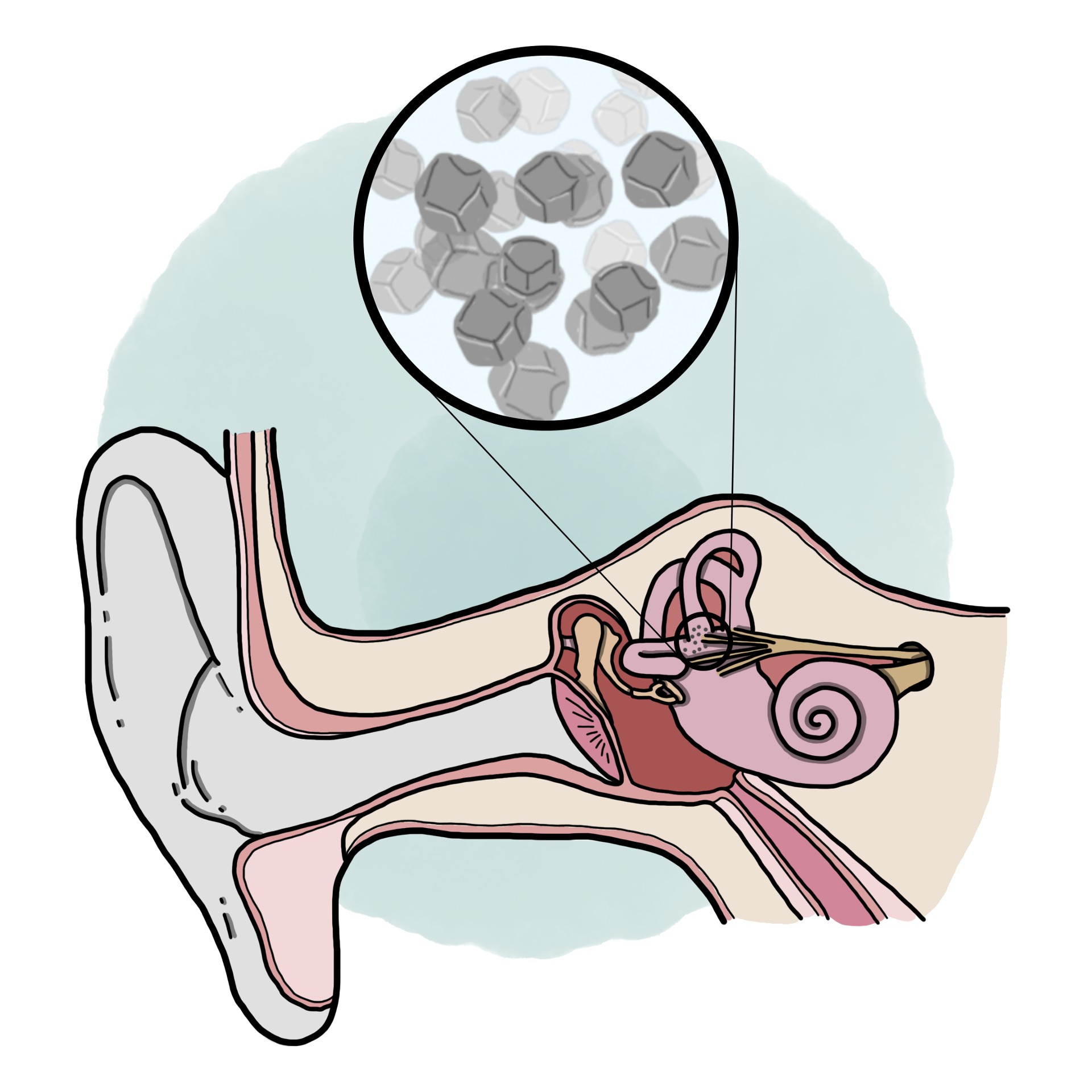 Benign positional vertigo - Peripheral vertigo