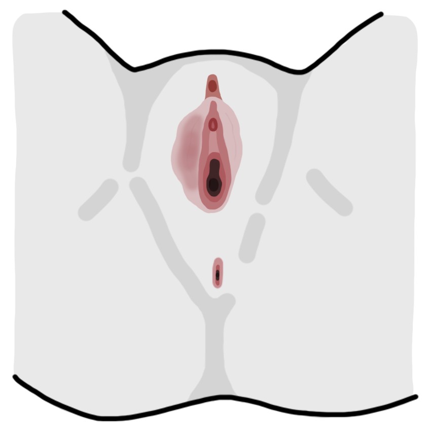 Dış dudak asimetrisi