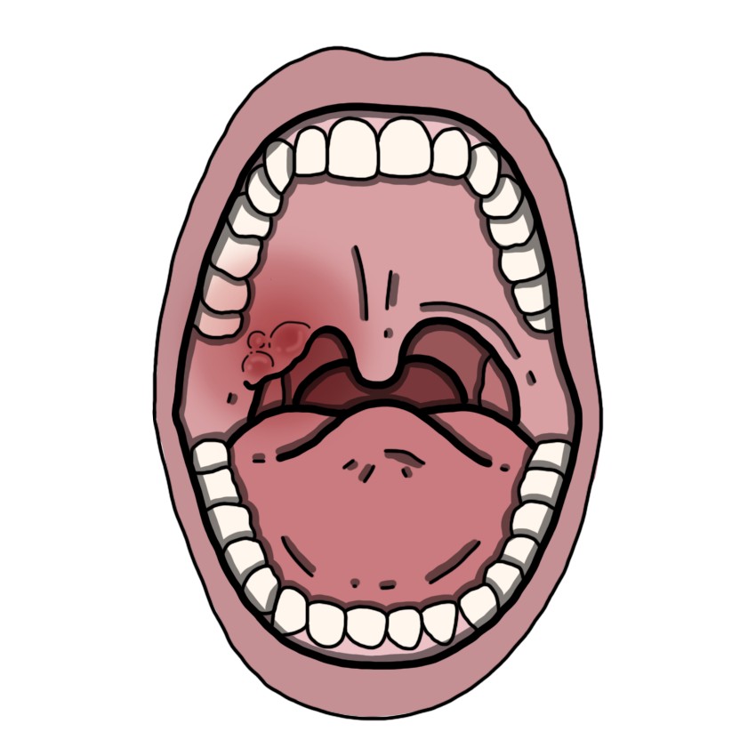 Mouth tumour - Squamous cell carcinoma