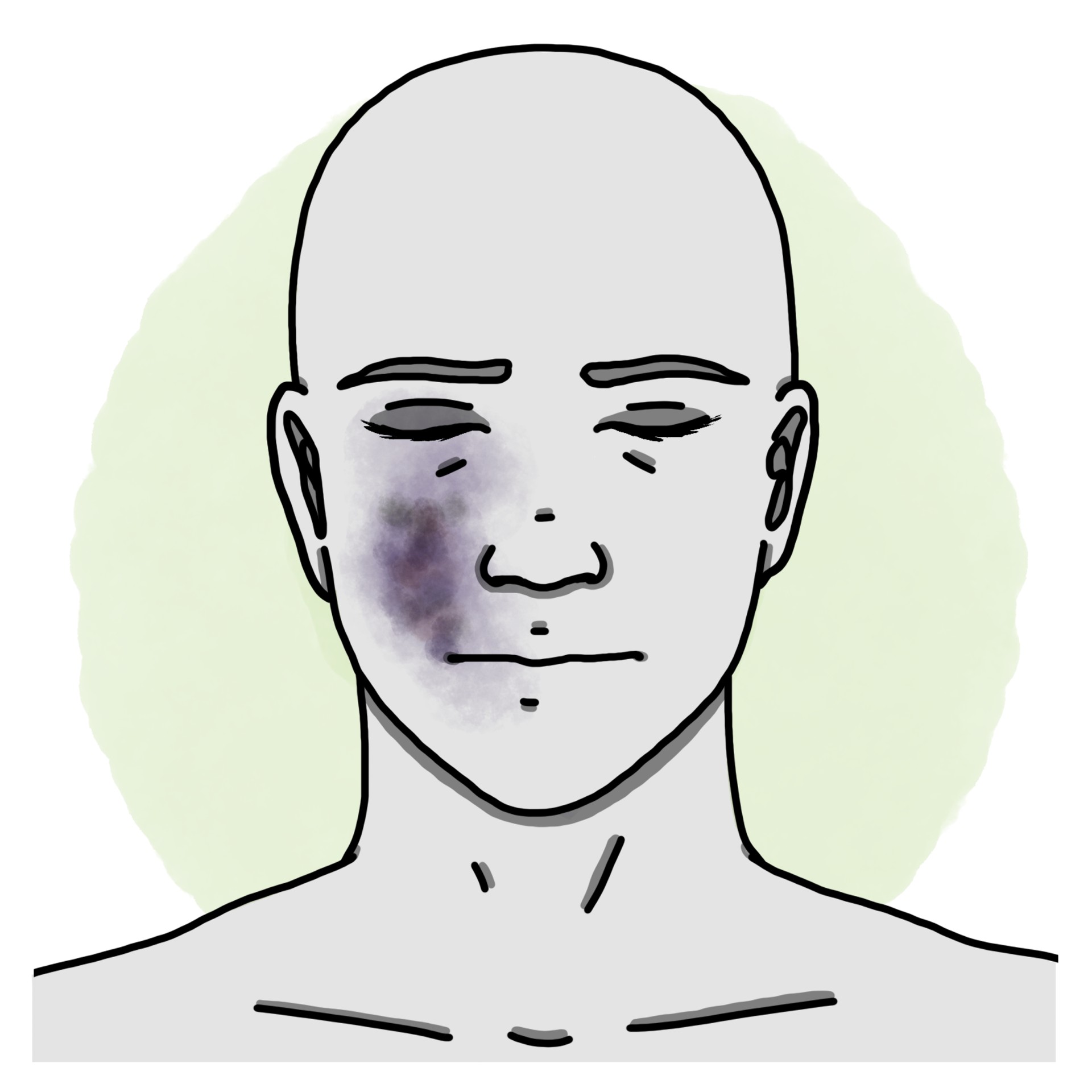 Face trauma - Face contusion