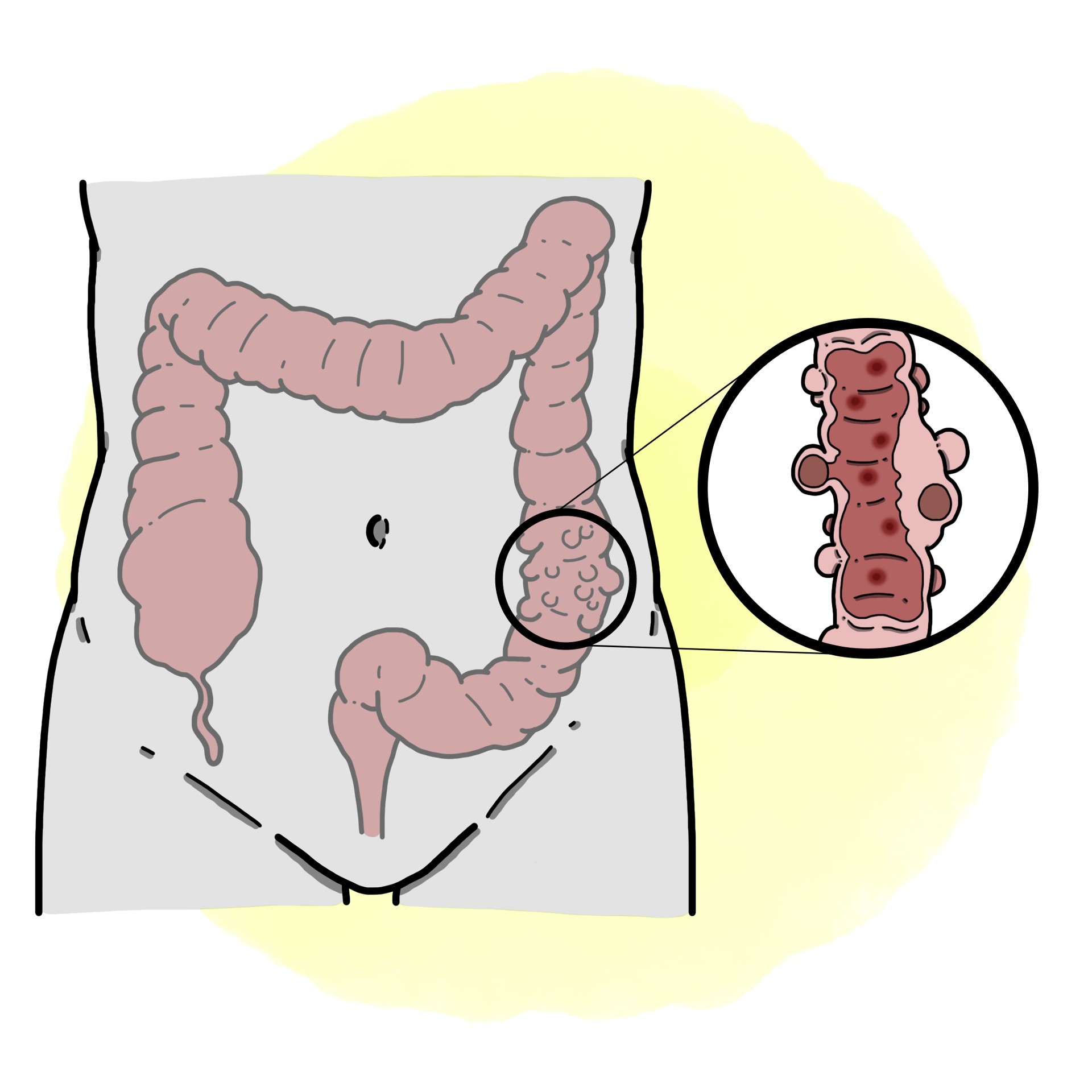 Diverticulitis