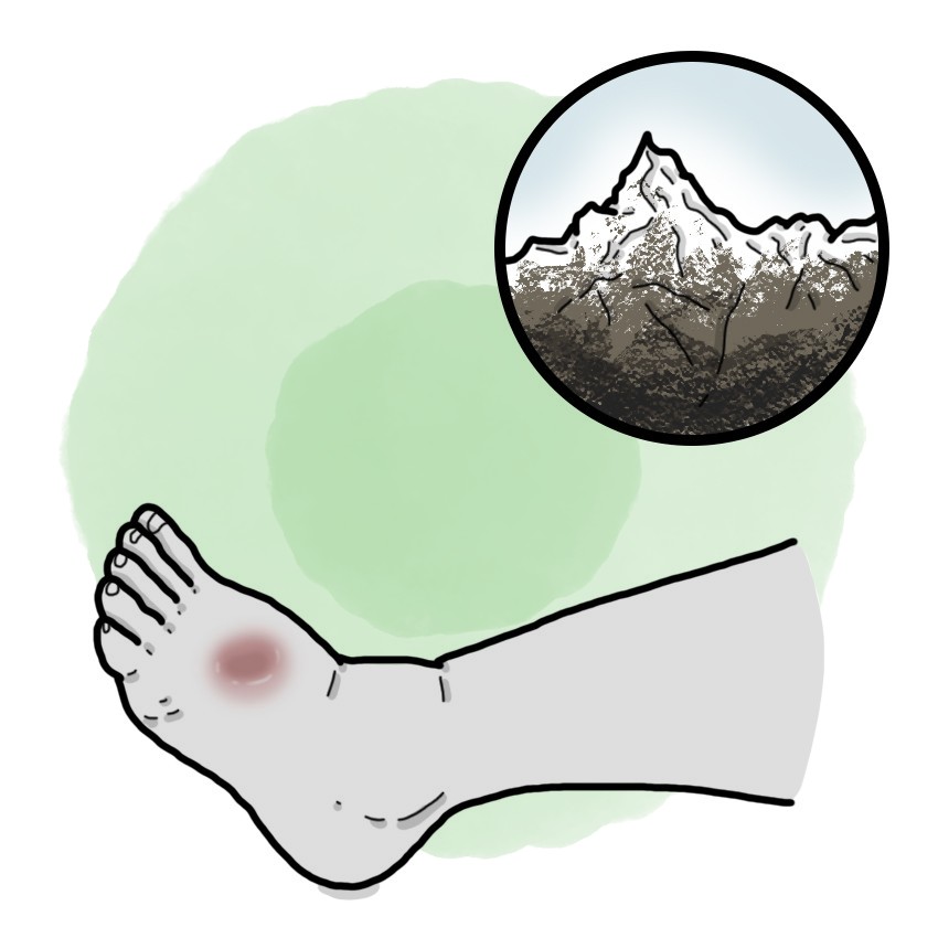 High-altitude peripheral oedema