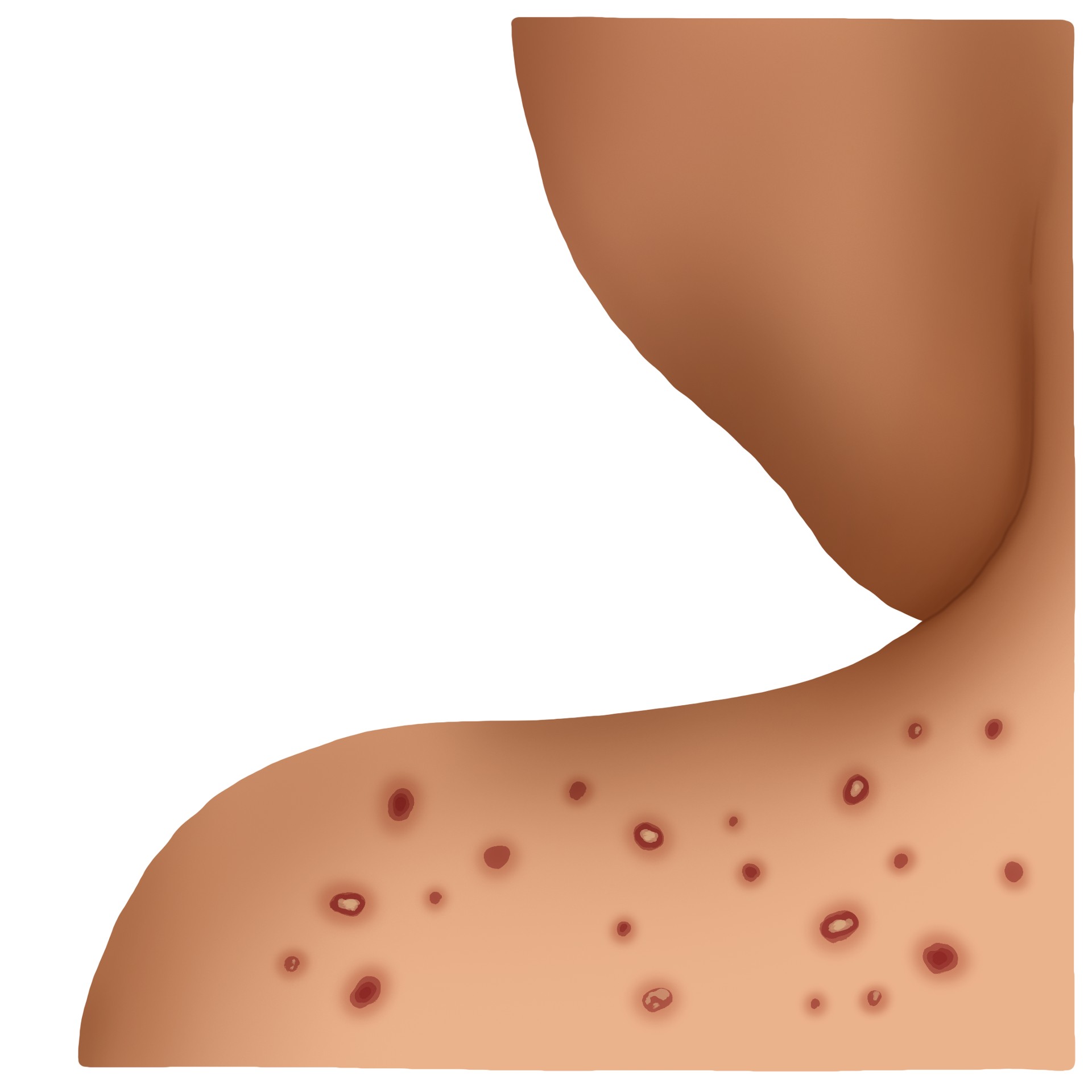 Chickenpox (Paediatrics)