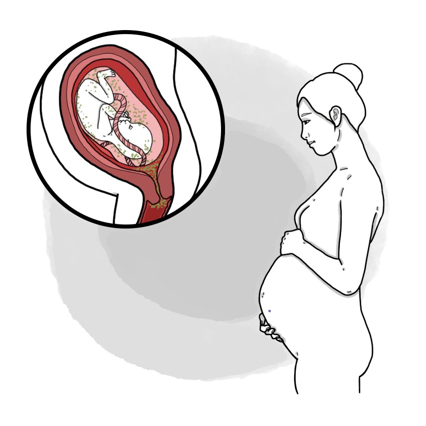 Intraamniotic infection - Corioamnionitis