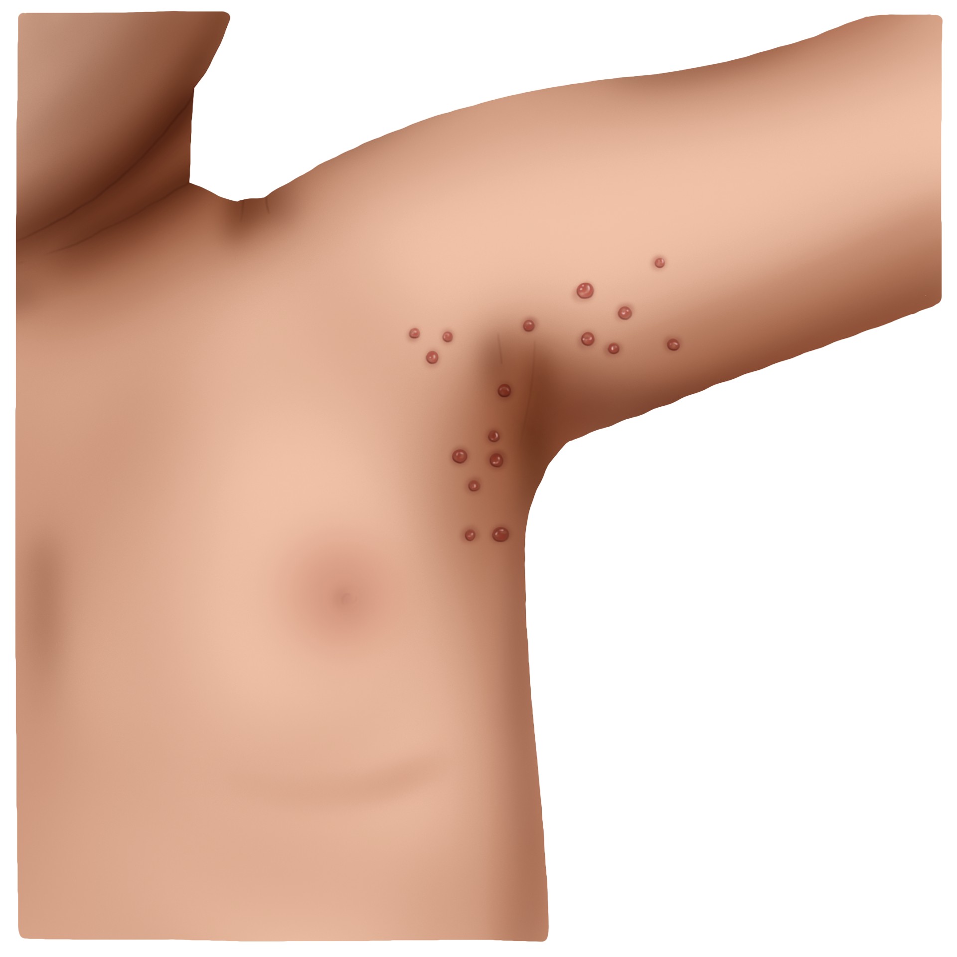 Molusco contagioso - molluscum contagiosum - Molluscum contagiosum (Pediatria)