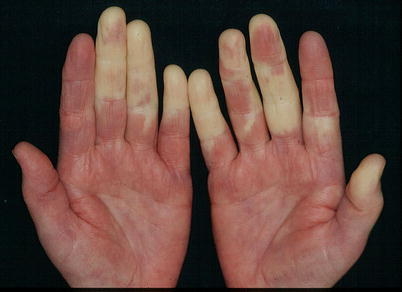 Raynaud's phenomenon