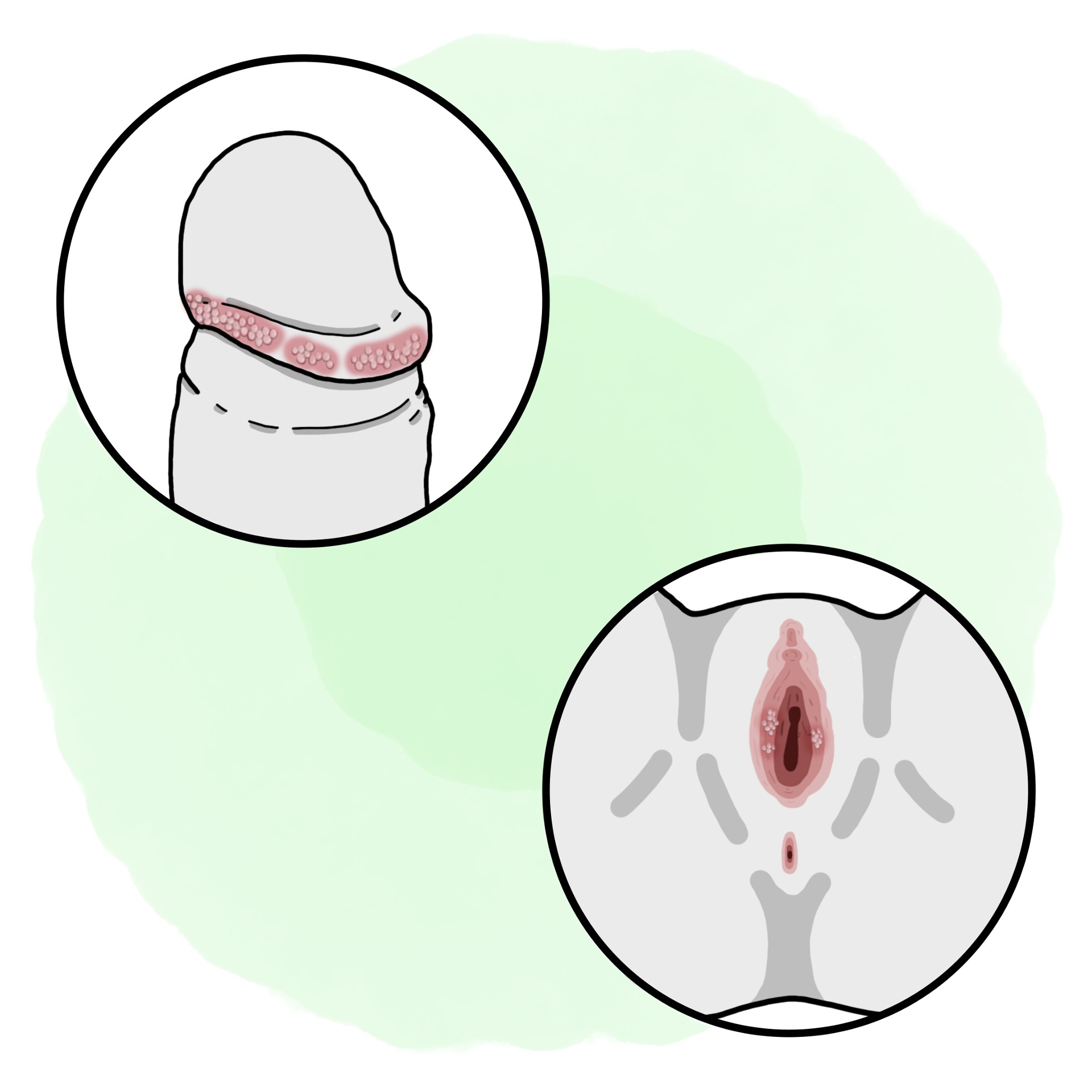 Pearly genital papules - Hirsuties papillaris genitalis