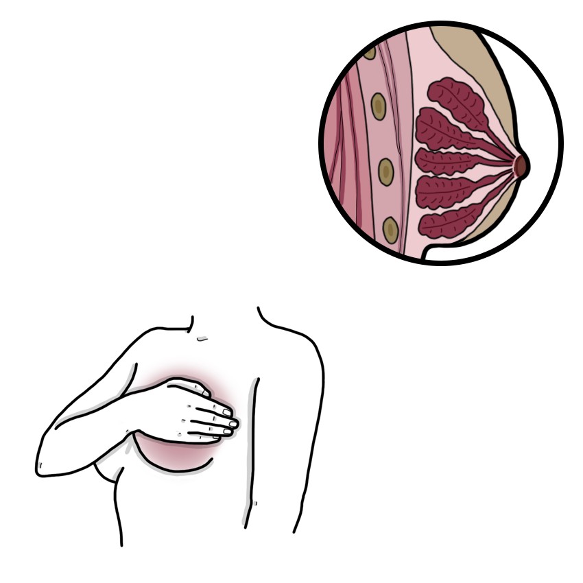 Puerperal breast engorgement
