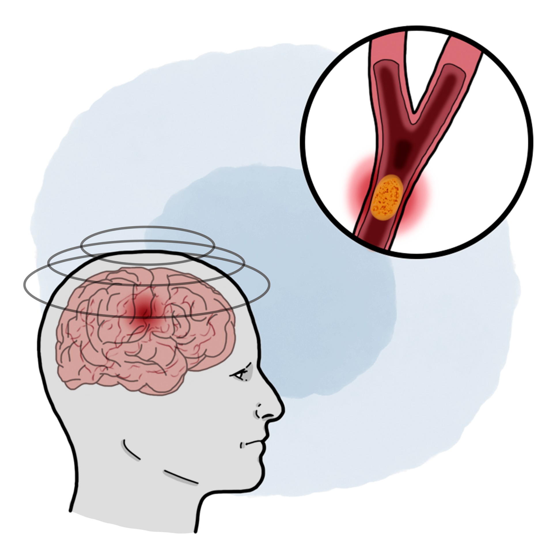 Central vertigo due to vertebrobasilar insufficiency - Vertebrobasilar transitory ischaemic accident