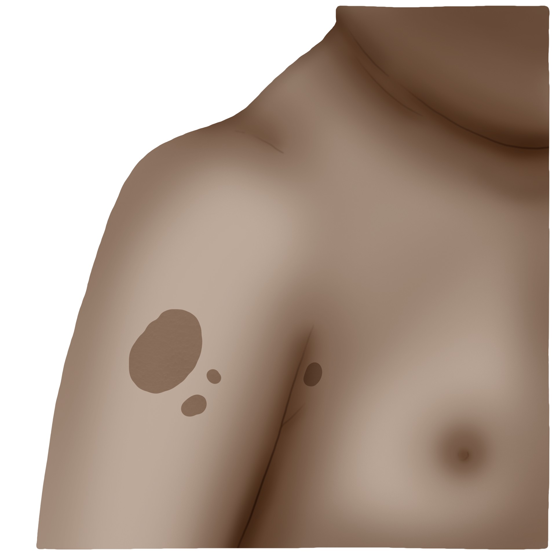 Neurofibromatosis type 1 - Von Recklinghausen's disease (Paediatrics)