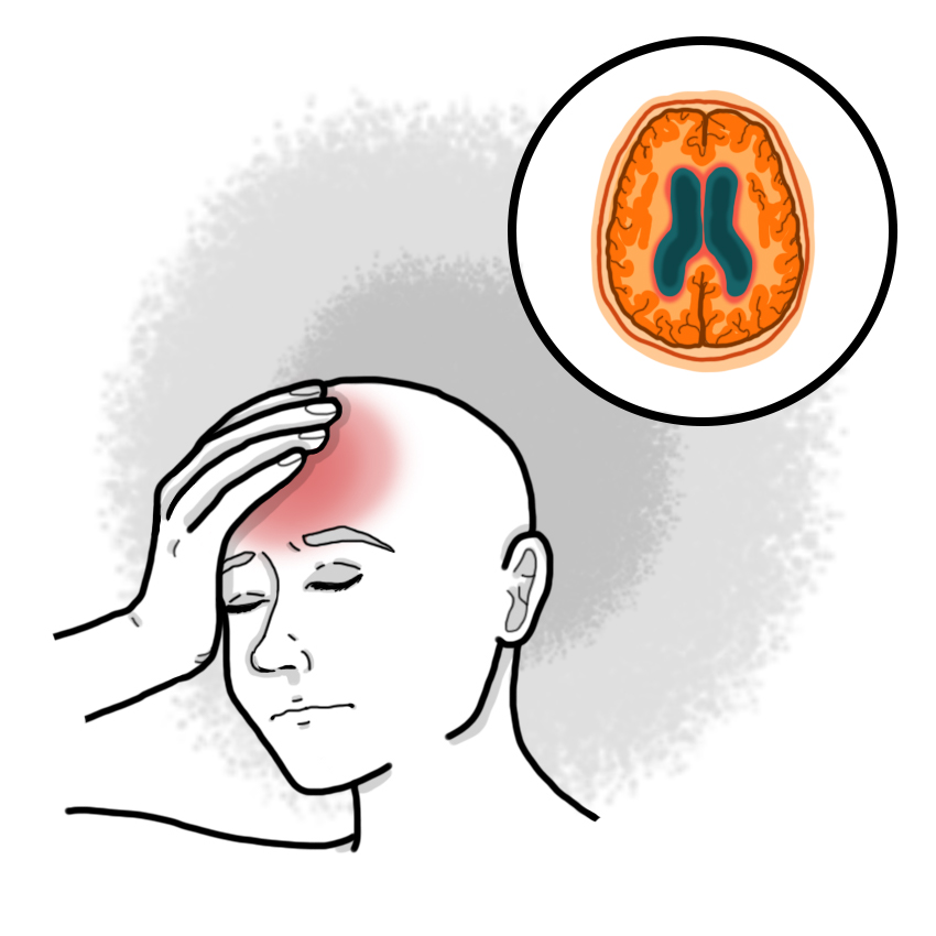 Normal pressure hydrocephalus (NPH)