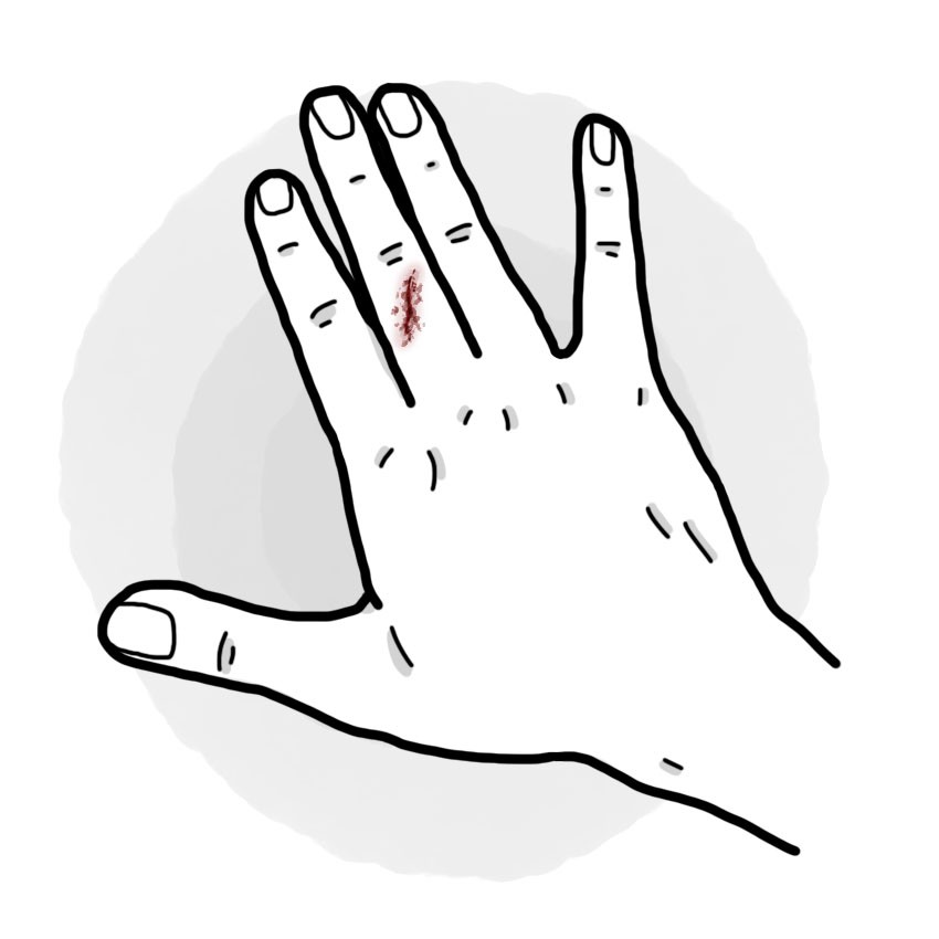 Finger wound
