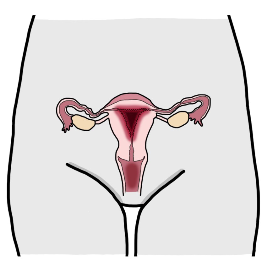 Endometrial hyperplasia