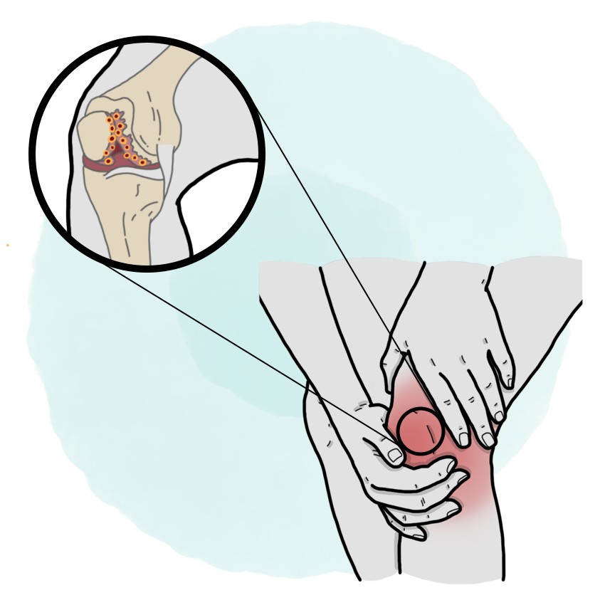 Septic arthritis (Paediatrics)