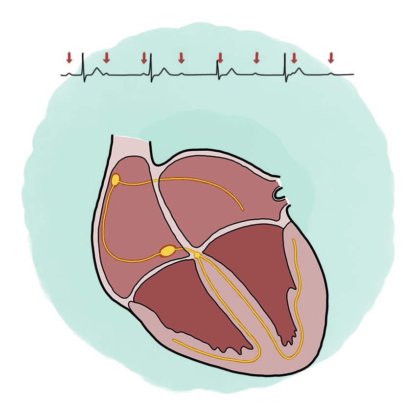 Third-degree atrioventricular block