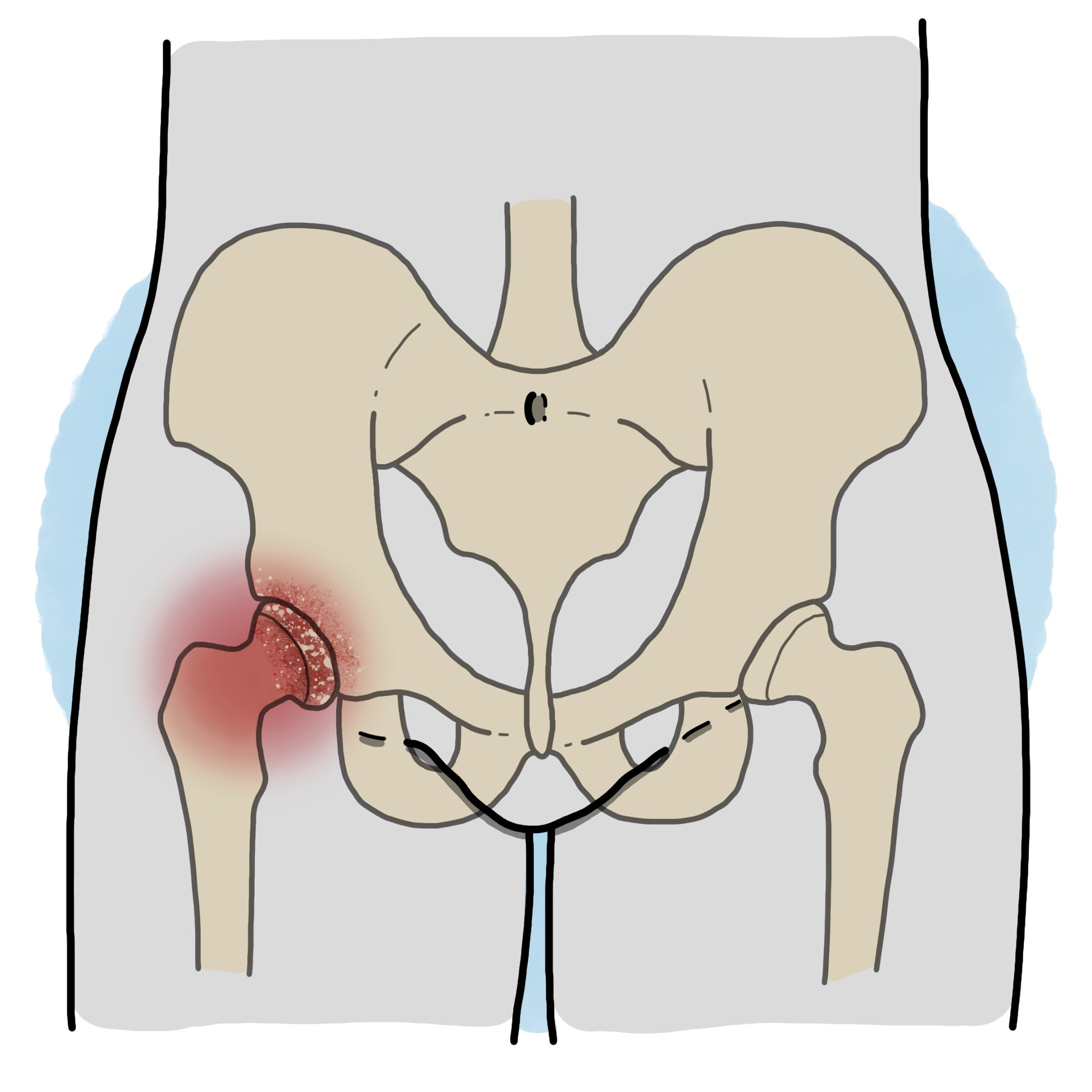 Osteoarthritis of the hip - Coxarthrosis