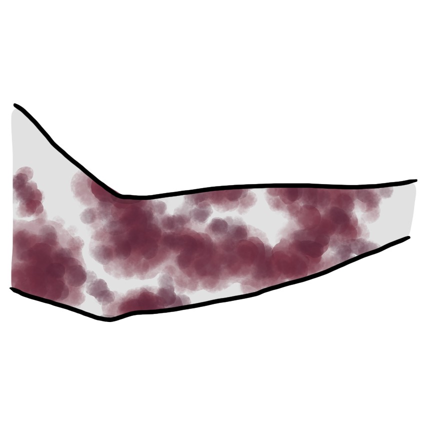 Kırmızı-morumsu lekeler içeren cilt (purpurik döküntü)