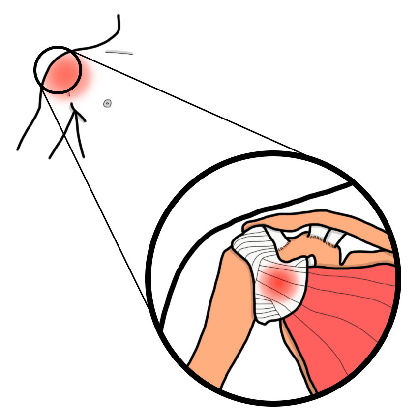 Painful shoulder due to rotator cuff disease