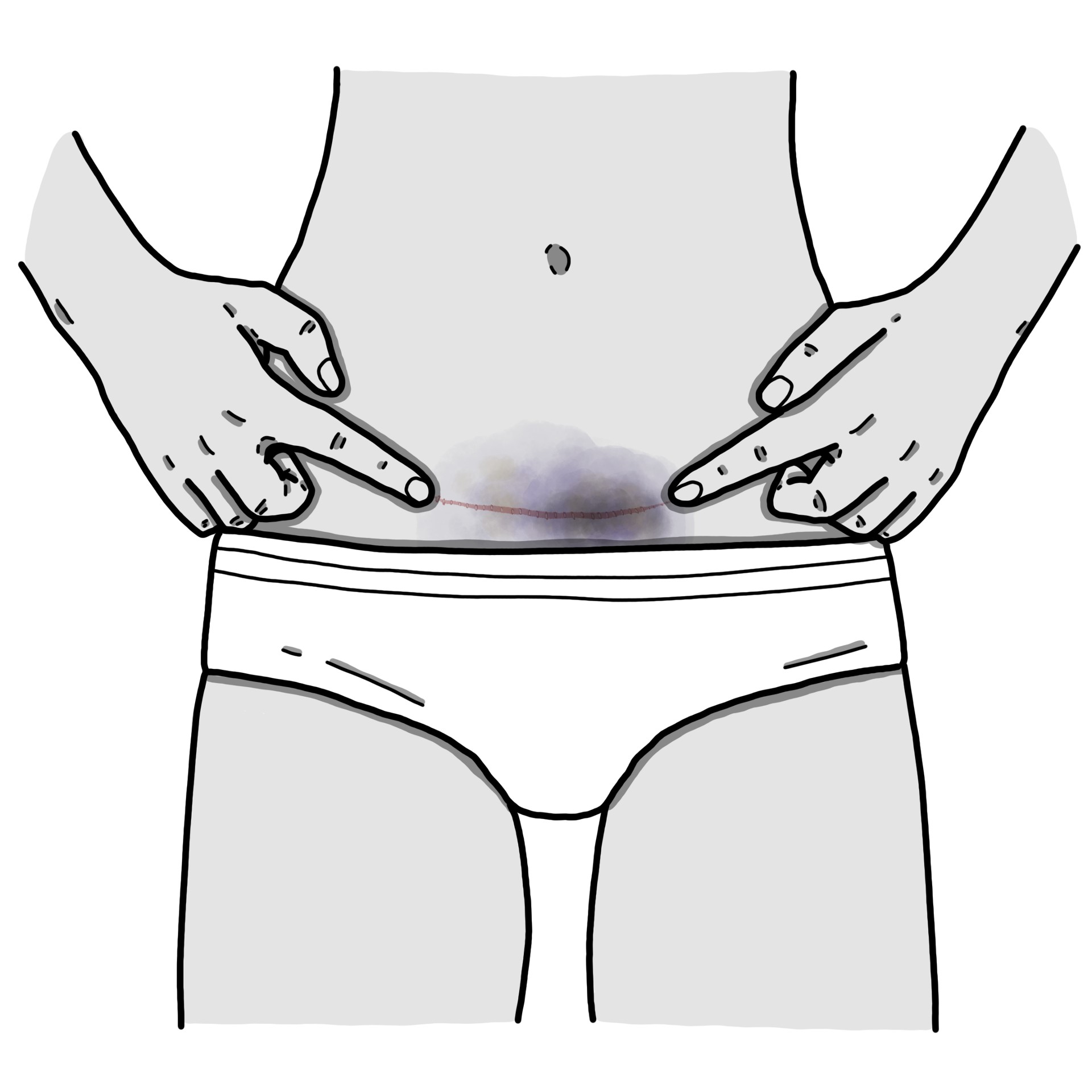 Haematoma in caesarean wound