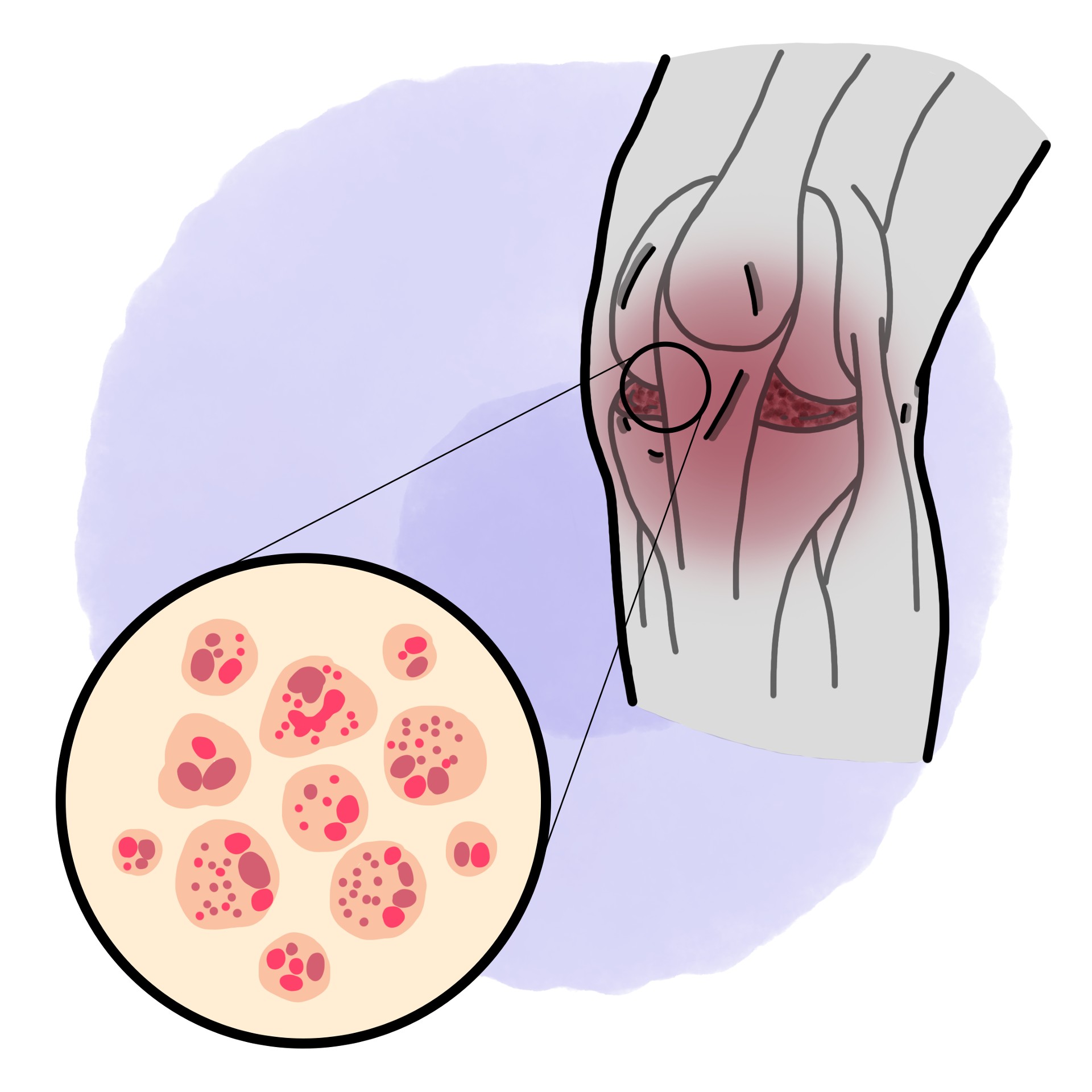 Gonococcal septic arthritis