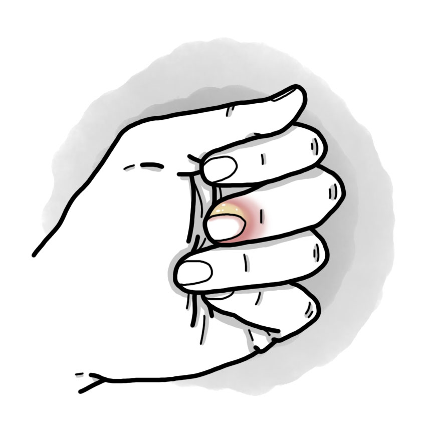 Periungual paronychia