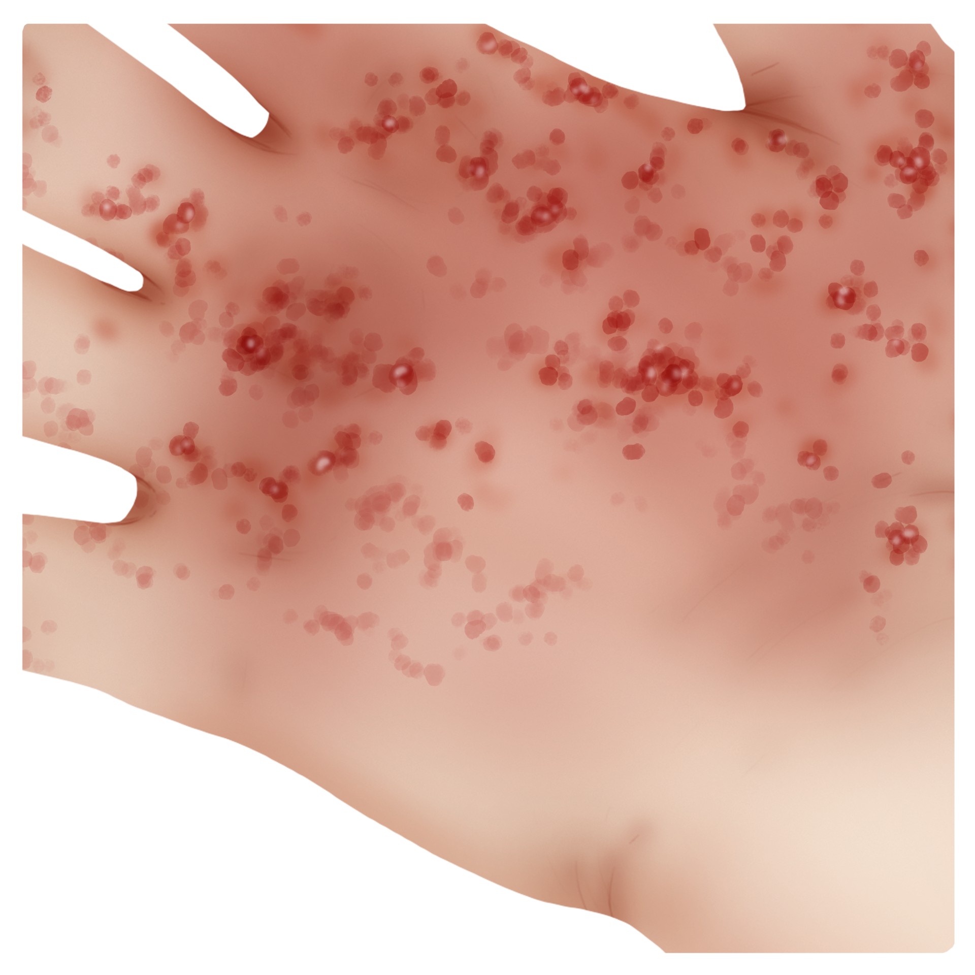 Atopic eczema - Atopic dermatitis in non-lactating child (Paediatrics)