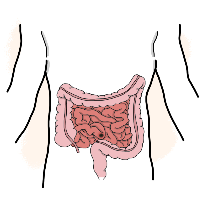 Small intestine perforation