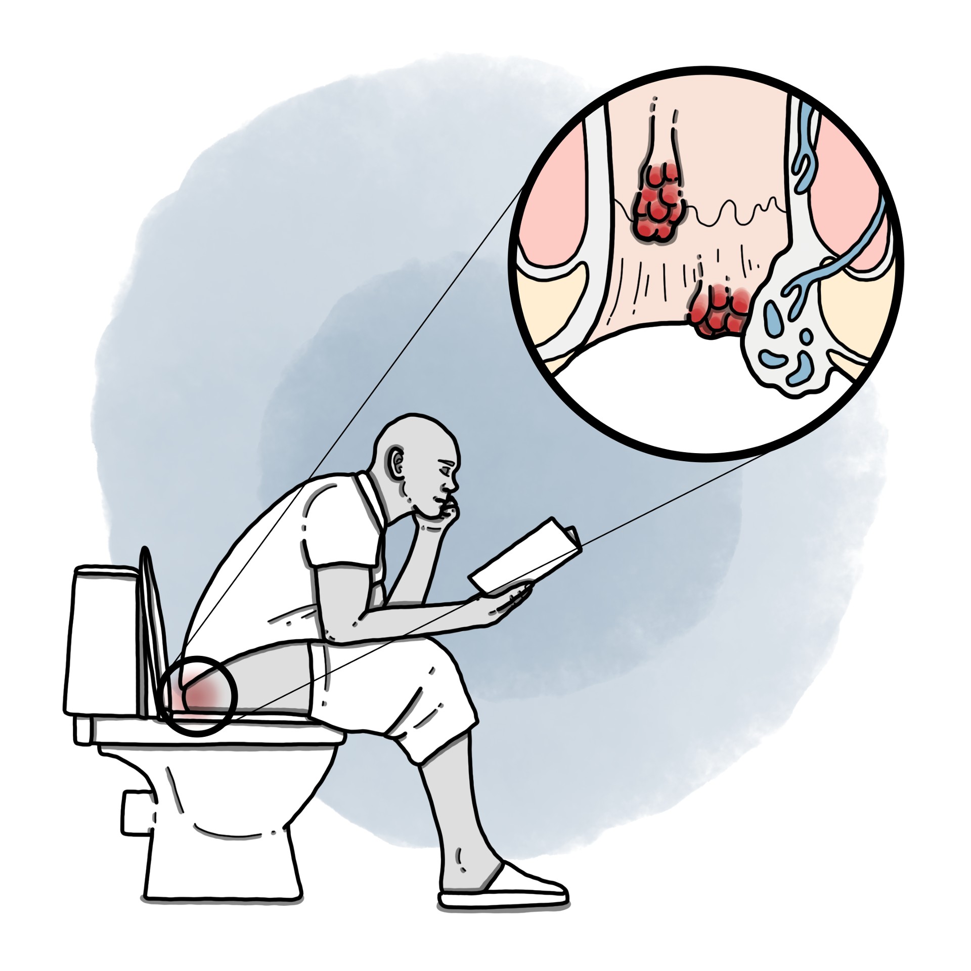 Haemorrhoids - Haemorrhoidal disease