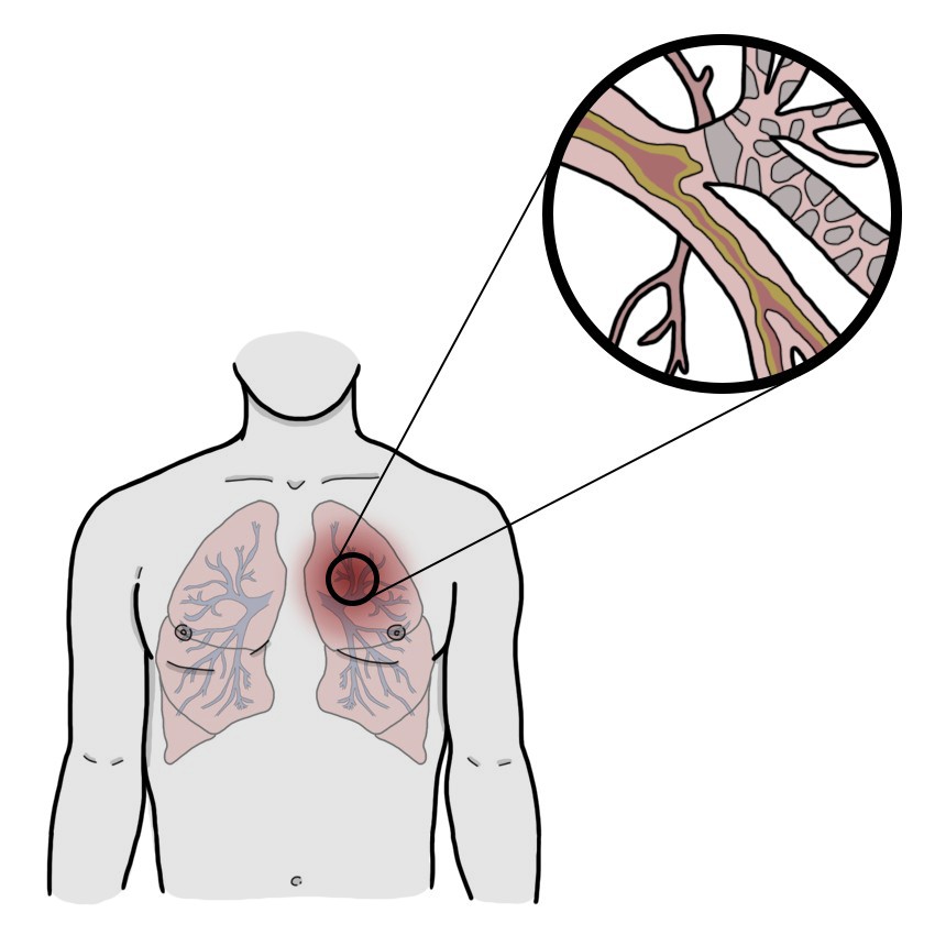 Reichlicher, zäher Lungenschleim