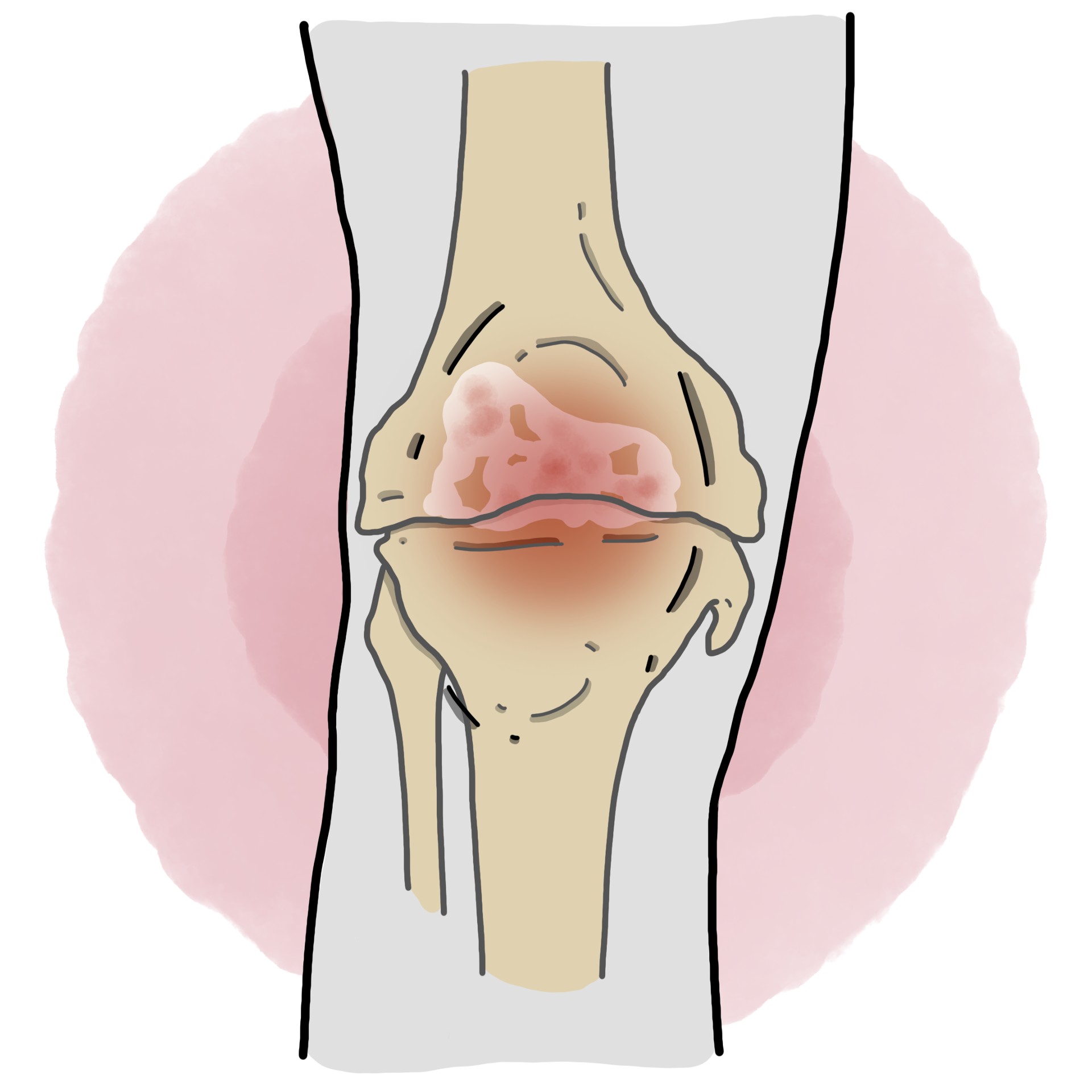 Knee osteoarthritis - Gonarthrosis