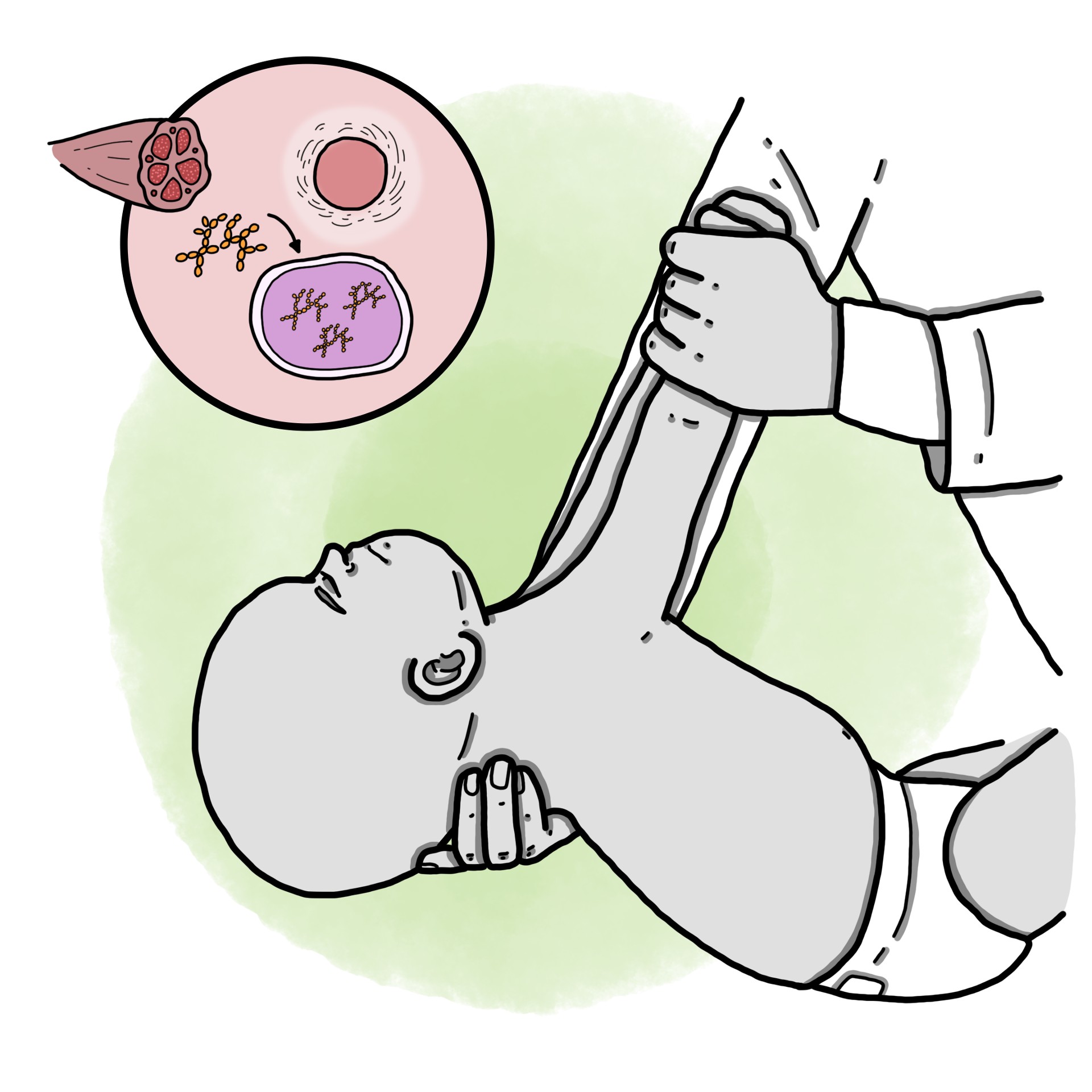 Pompe disease - infantile-onset (Paediatrics)