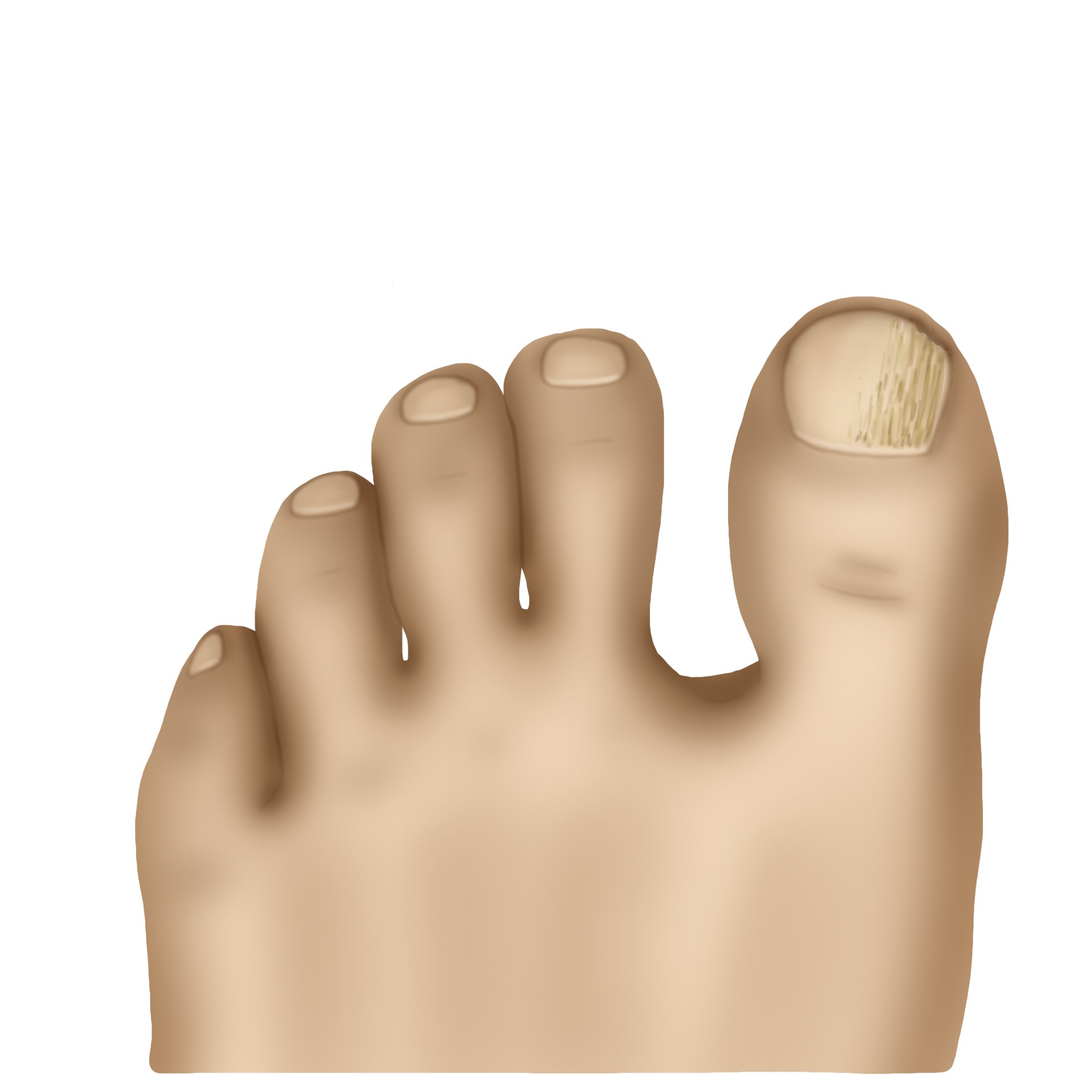 Fungal nail infection - Onychomycosis