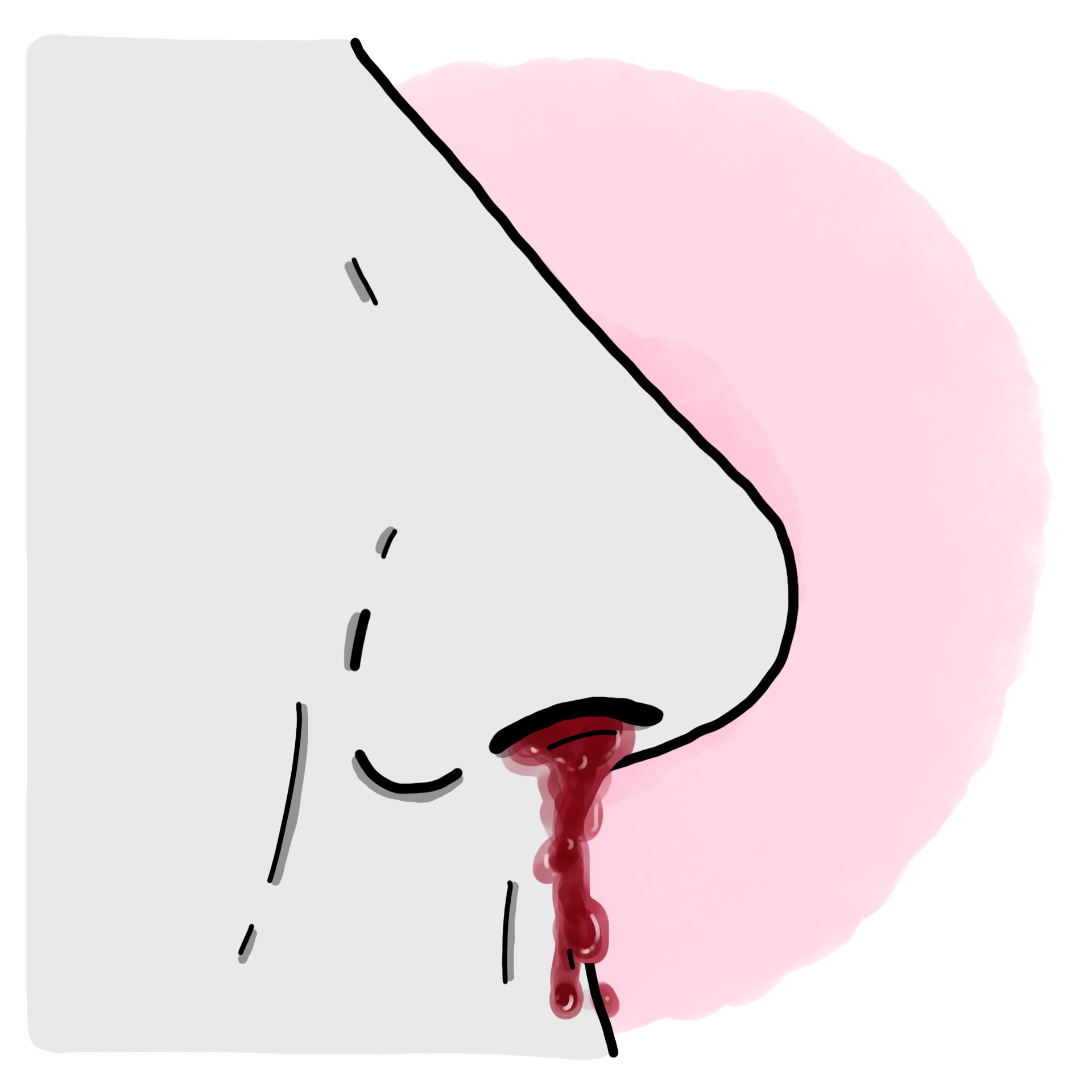 Nosebleed - Epistaxis