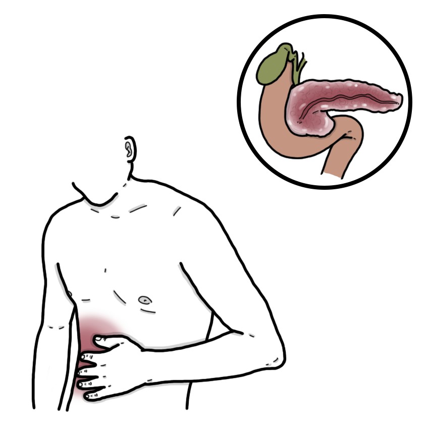 Pancreatitis