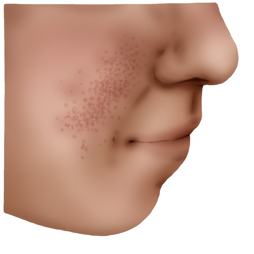 Tuberous sclerosis - Bourneville-Pringle disease