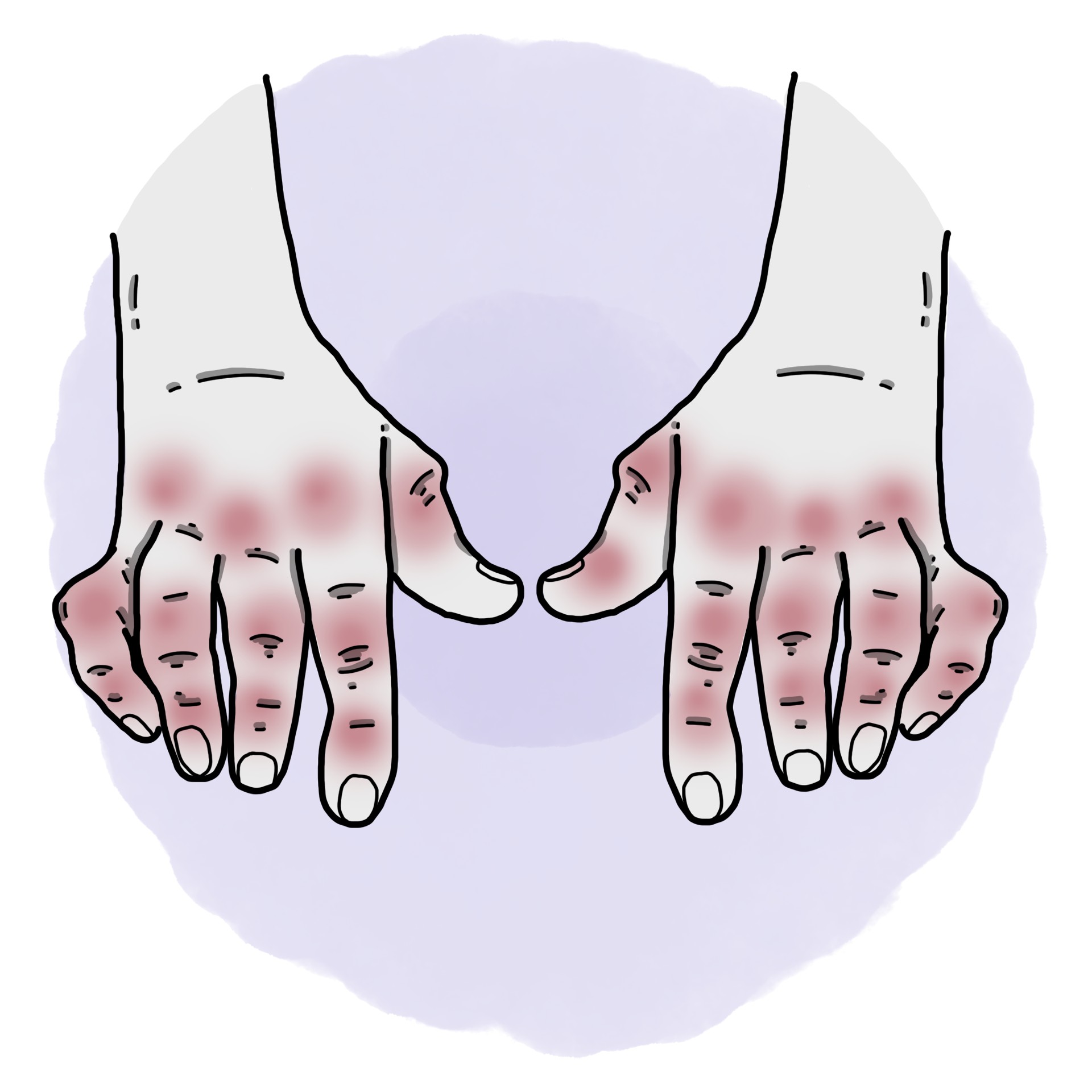 Rheumatoid arthritis