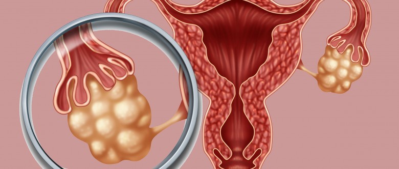 Ovarian hyperstimulation syndrome