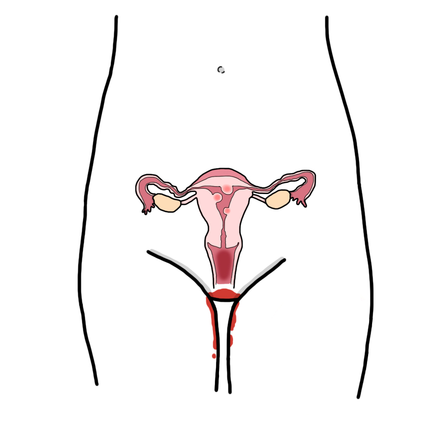 Female genital bleeding due to organic causes