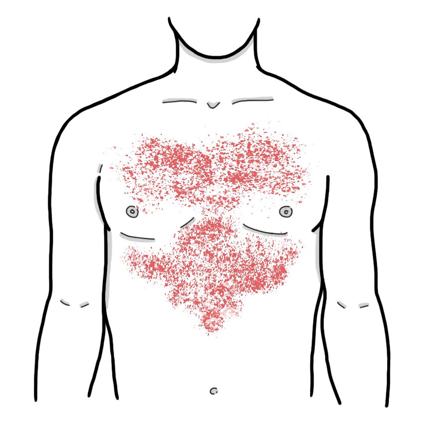 Scarlet fever (Paediatrics)