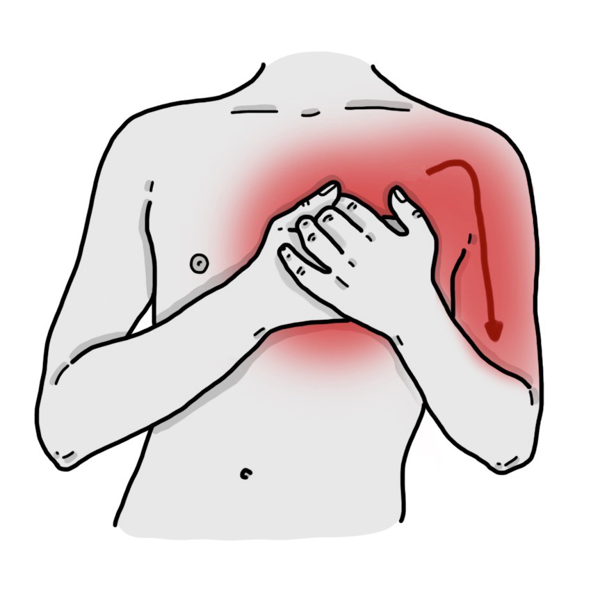 Dor no peito irradiando para os braços