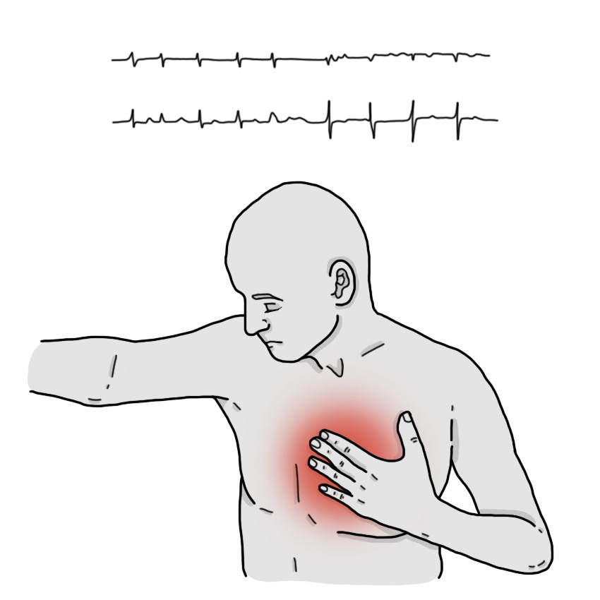 Rapid atrial fibrillation