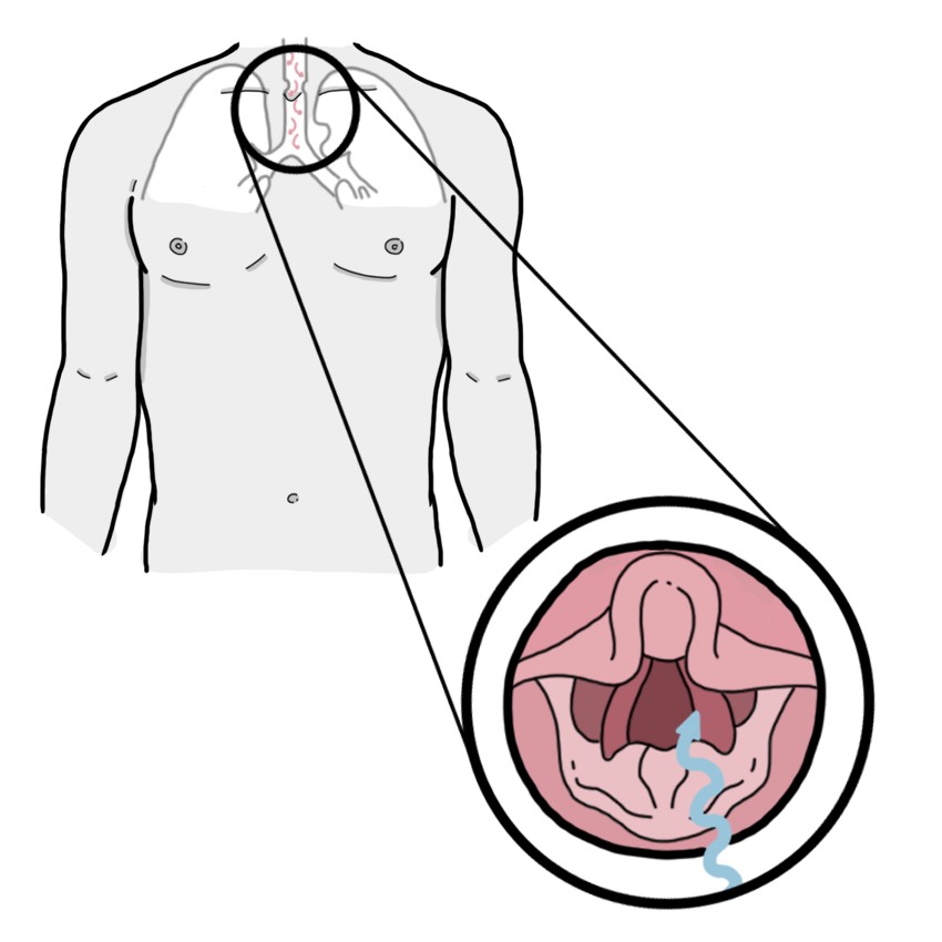 Inspiratory and expiratory stridor