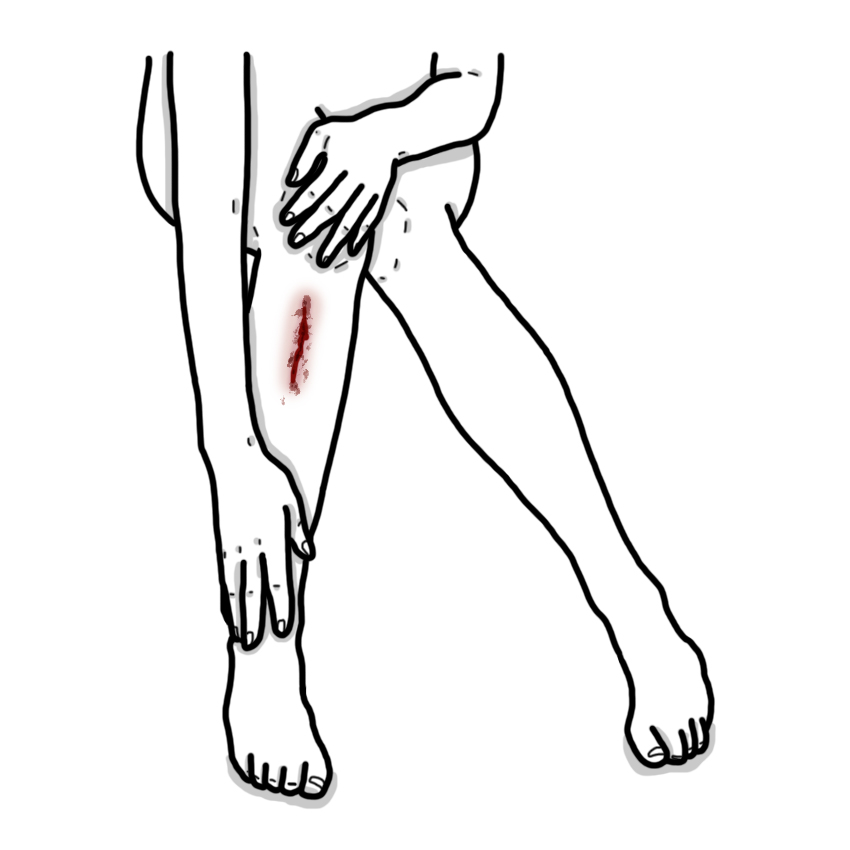 Leg wound