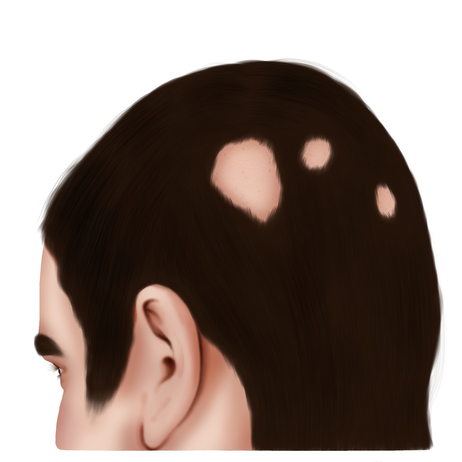 Alopecia areata