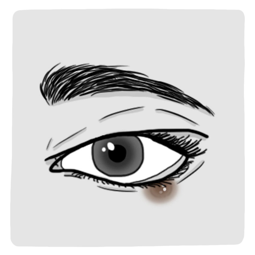 Hard bultje op het ooglid