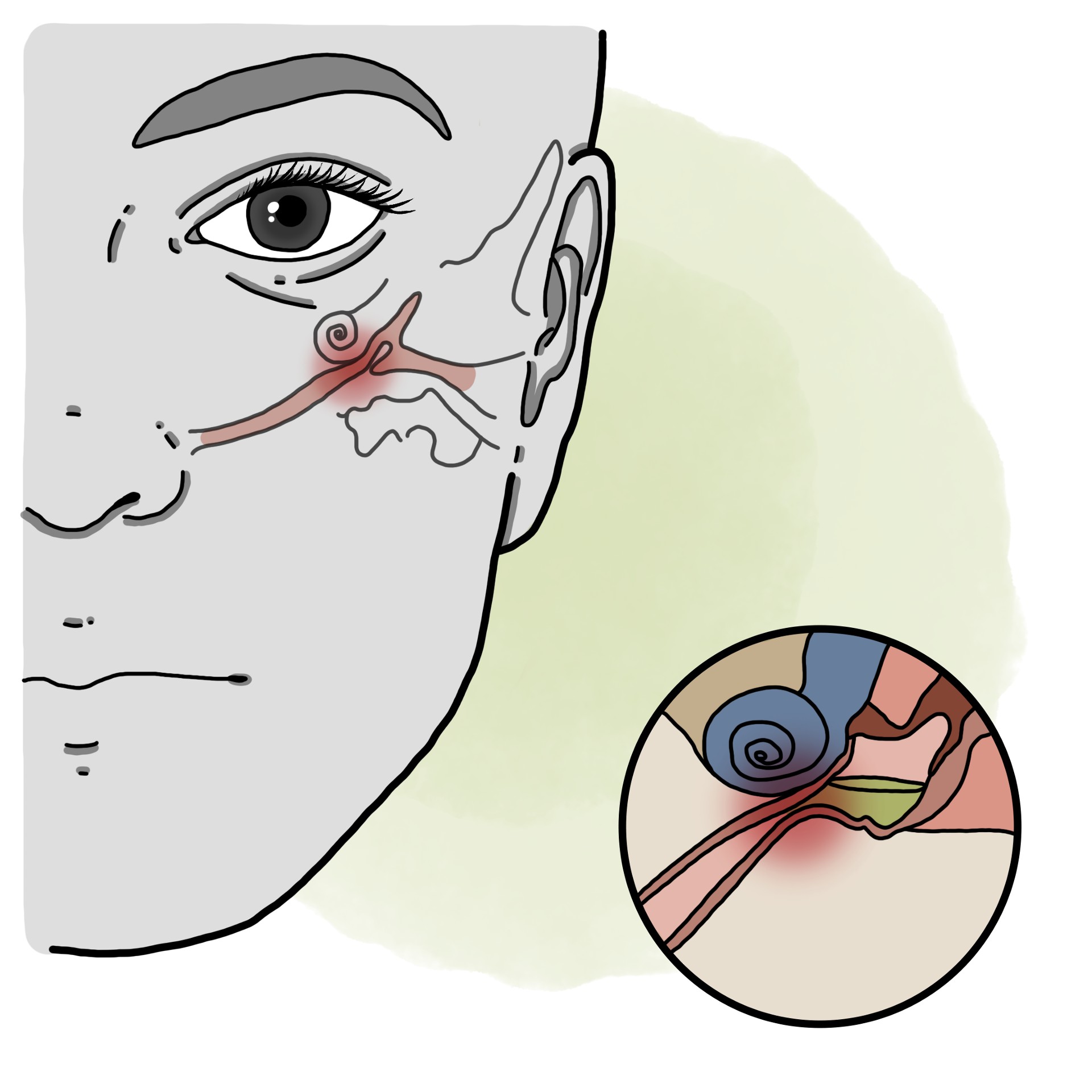 Eustachian tube dysfunction