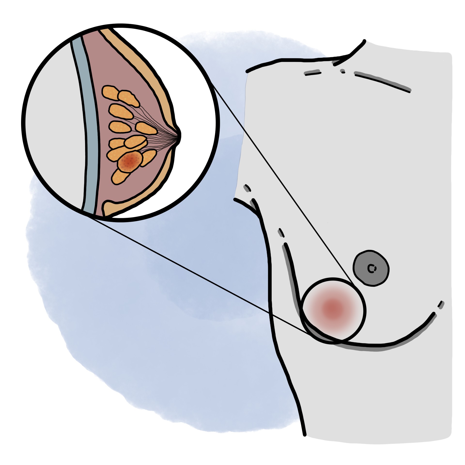 Breast cancer - Breast neoplasm