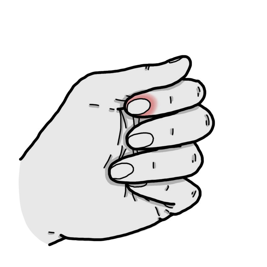 Dolor en zona periungueal