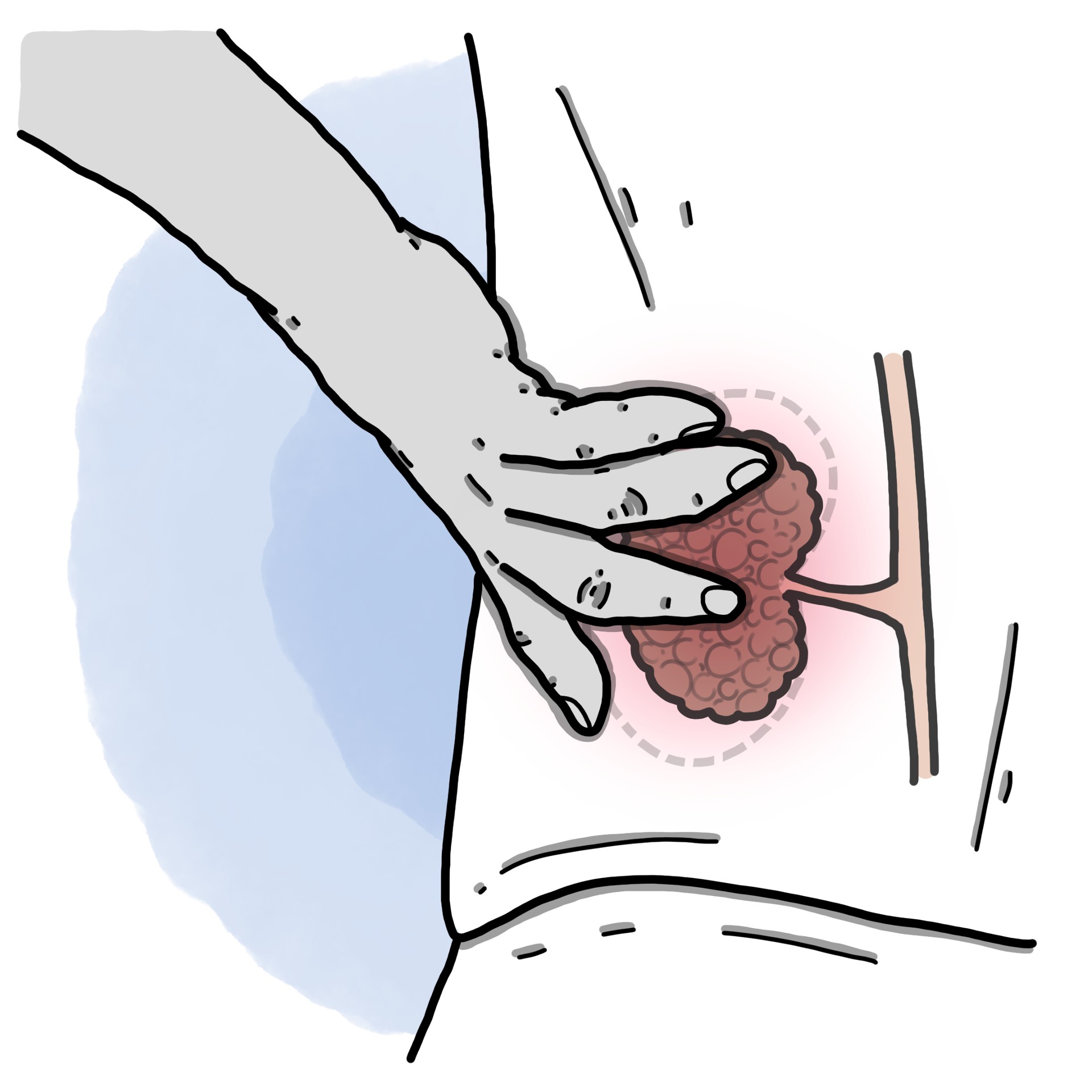 Chronic kidney failure - Chronic kidney disease