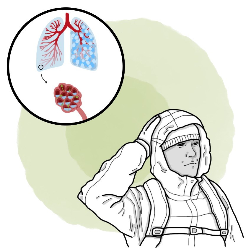 High-altitude pulmonary oedema - HAPO